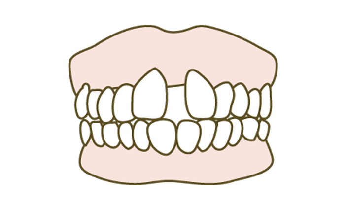 すきっ歯の改善