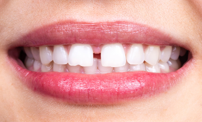 すきっ歯の治療方法